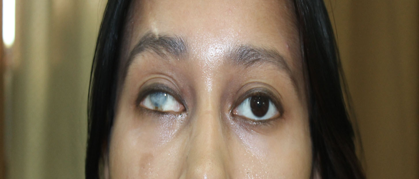 Cosmetic Scleral Shells